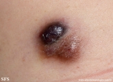 dermatofibrosarcoma protuberans
