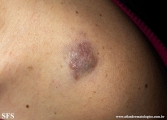 dermatofibrosarcoma protuberans