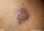 dermatofibrosarcoma protuberans