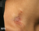 dermatofibrosarcoma protuberans