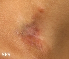 dermatofibrosarcoma protuberans