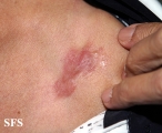 dermatofibrosarcoma protuberans