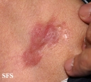 dermatofibrosarcoma protuberans