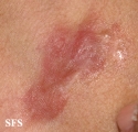dermatofibrosarcoma protuberans