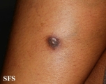 dermatofibrosarcoma protuberans