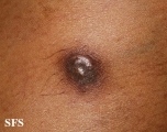 dermatofibrosarcoma protuberans