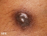 dermatofibrosarcoma protuberans