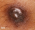 dermatofibrosarcoma protuberans
