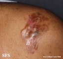 dermatofibrosarcoma protuberans
