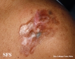dermatofibrosarcoma protuberans