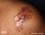 dermatofibrosarcoma protuberans