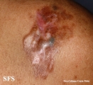 dermatofibrosarcoma protuberans