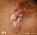 dermatofibrosarcoma protuberans