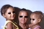 anhidrotic ectodermal dysplasia
