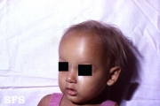 anhidrotic ectodermal dysplasia