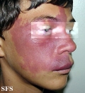 sturge-weber syndrome