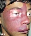 sturge-weber syndrome