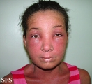 drug reactions