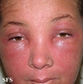 drug reactions
