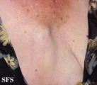 mucinous eccrine carcinoma