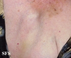 mucinous eccrine carcinoma
