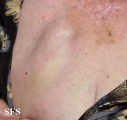 mucinous eccrine carcinoma