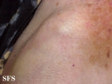 mucinous eccrine carcinoma