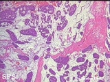 mucinous eccrine carcinoma