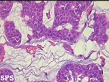 mucinous eccrine carcinoma