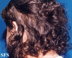 trichotillomania-trichobezoars