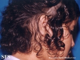 trichotillomania-trichobezoars