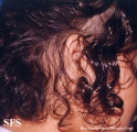 trichotillomania-trichobezoars