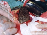 trichotillomania-trichobezoars