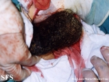 trichotillomania-trichobezoars