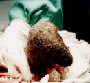 trichotillomania-trichobezoars