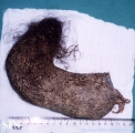 trichotillomania-trichobezoars