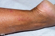 lichen_planus_pemphigoides