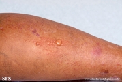 lichen_planus_pemphigoides