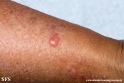 lichen_planus_pemphigoides