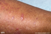 lichen_planus_pemphigoides