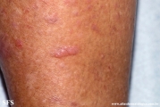 lichen_planus_pemphigoides