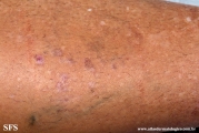 lichen_planus_pemphigoides