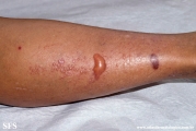 lichen_planus_pemphigoides