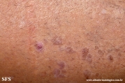 lichen_planus_pemphigoides