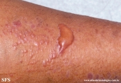 lichen_planus_pemphigoides