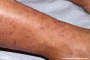 lichen_planus_pemphigoides