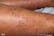 lichen_planus_pemphigoides