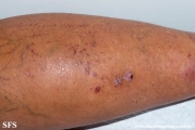 lichen_planus_pemphigoides