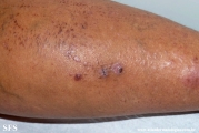 lichen_planus_pemphigoides