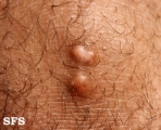 xanthoma tuberosum